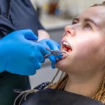 Tooth Extractions
