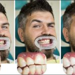Tooth Removal in Orleans