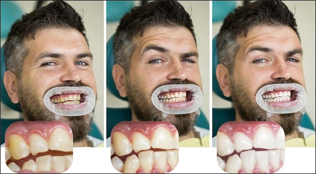 Tooth Removal in Orleans